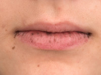 Peutz-Jeghers syndrome