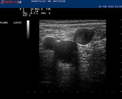 Oorsprong van de vena saphena magna: Mickey Mouse figuur