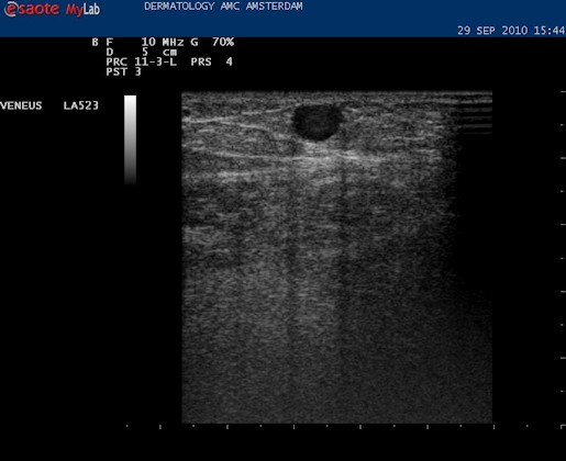 Accesoire vena saphena magna