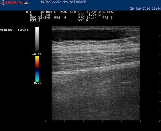 Accesoire vena saphena magna