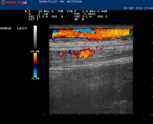 Accesoire vena saphena magna