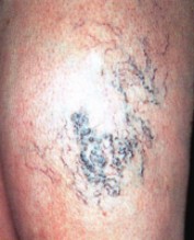 Blauwe teleangiectasien, groter kaliber dan besenreiser. Daartussen ook enkele besenreiser. Blauwe teleangiectasien, groter kaliber dan besenreiser. Daartussen ook enkele besenreiser.