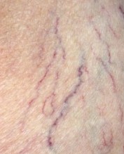 Varicose veins Varicose veins