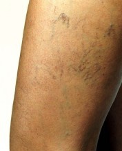 Besenreiser, iets groter kaliber, blauwiger tint. Ook schemert vaag een onderliggend netwerk van blauwe reticulaire venen door. Besenreiser, iets groter kaliber, blauwiger tint. Ook schemert vaag een onderliggend netwerk van blauwe reticulaire venen door.