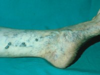 blow-outs in venae perforantes