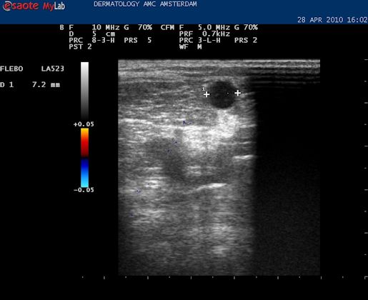 Diameter opmeten van de vena saphena magna