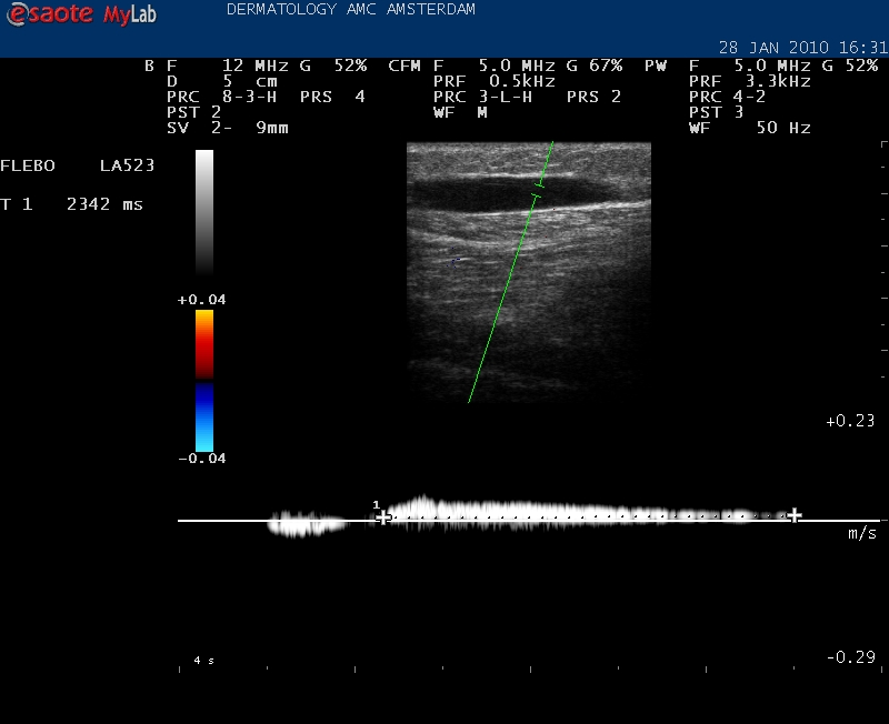 Reflux meten in een insufficiente vena saphena magna