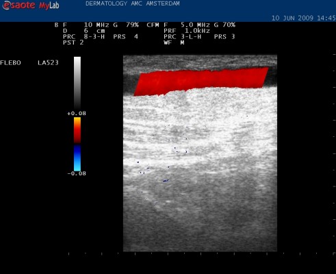 Insufficient great saphenous vein, reflux in red (click on photo to enlarge) Insufficient saphenous vein, reflux in red