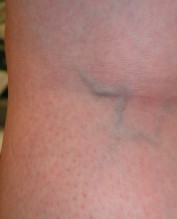 Reticulaire venen, groter kaliber. Dit is op de grens van normaal. Het is normaal dat in de knieholte het reticulaire netwerk van venen wat meer zichtbaar is dan op andere plaatsen. Reticulaire venen, groter kaliber. Dit is op de grens van normaal. Het is normaal dat in de knieholte het reticulaire netwerk van venen wat meer zichtbaar is dan op andere plaatsen.