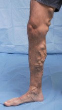 great saphenous vein varicose vein (click on photo to enlarge) Varicose veins