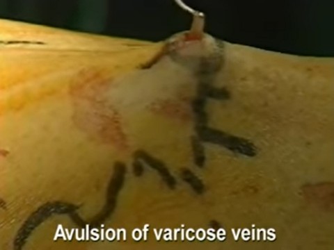 Video Muller procedure 1
