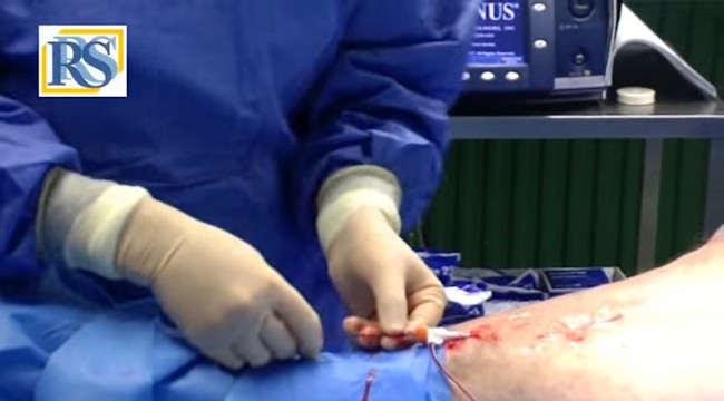 Video VNUS closure procedure