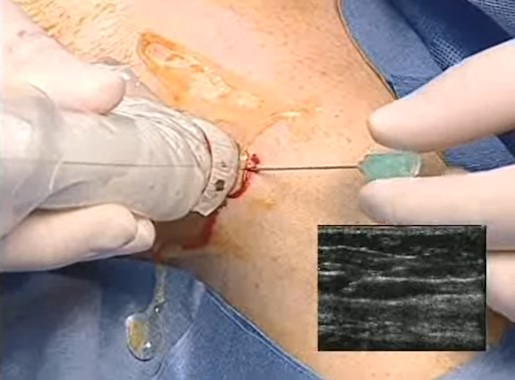 Video VNUS closure procedure