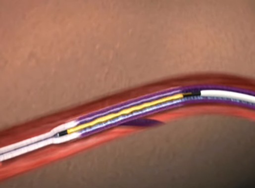 Video VNUS closure procedure
