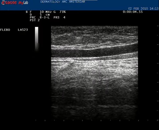 Video vena saphena magna