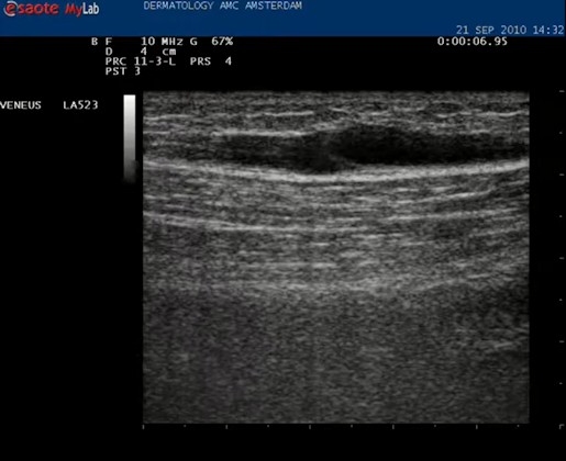 Video intact klepje in de vena saphena magna