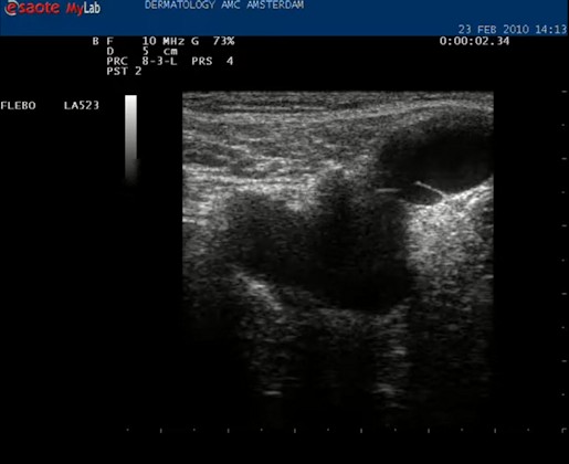 Video klep van de vena saphena magna crosse