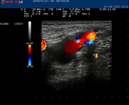 Video crosse insufficiëntie van de vena saphena magna