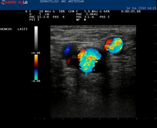 Video crosse insufficiëntie van de vena saphena magna