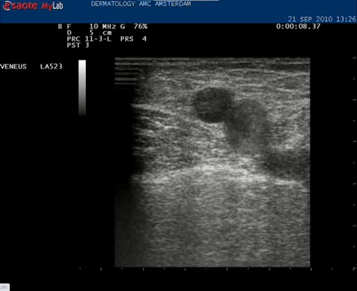 Video vena saphena magna die via een insufficiënte vena perforans wordt gevuld vanuit het diepe systeem