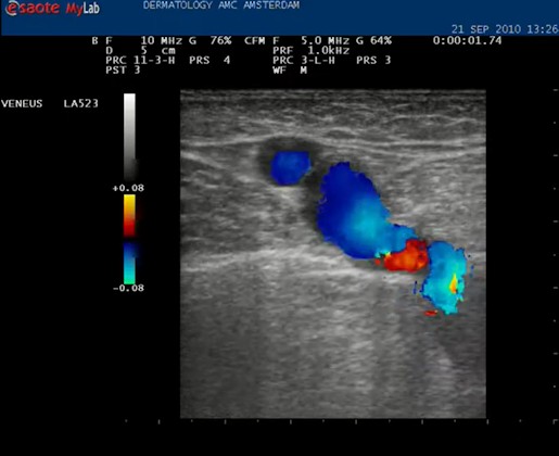 Video vena saphena magna die via een insufficiënte vena perforans wordt gevuld vanuit het diepe systeem