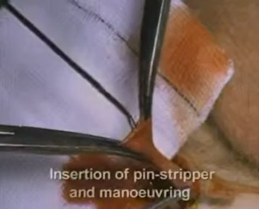 Video crossectomie + korte strip