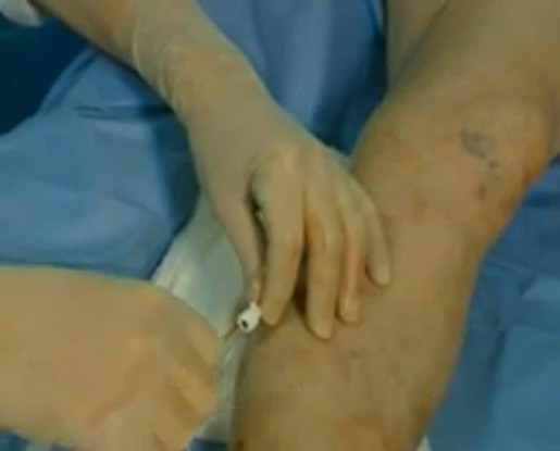 Video endovasculaire laser