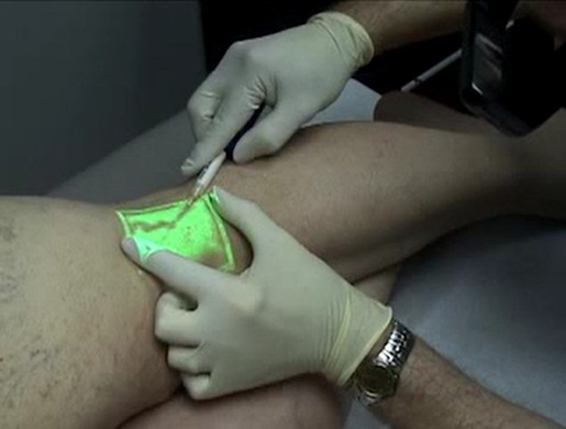 Video scleroseren van middelgrote varices, zichtbaar gemaakt met groen licht