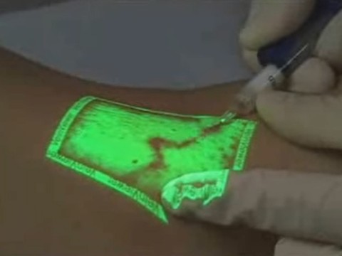 Video scleroseren van middelgrote varices, zichtbaar gemaakt met groen licht