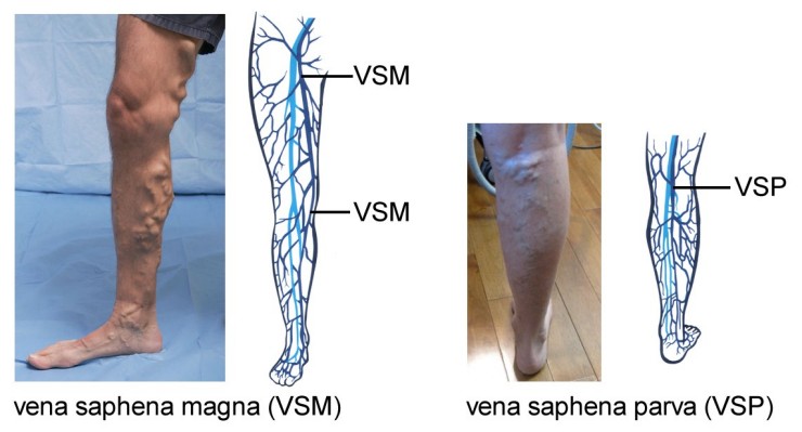 Varicose veins