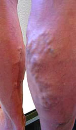 Stamvaricose van de vena saphena parva