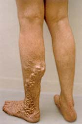 Stamvaricose van de vena saphena parva