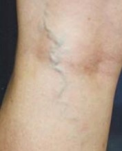 Middelgrote en kleinere venen Middelgrote en kleinere venen