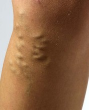 Varicose veins Varicose veins