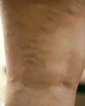 Varicose veins Varicose veins