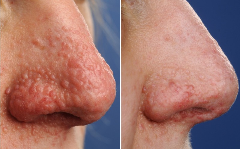 Behandeling van adenoma sebaceum met 0.2% sirolimuszalf - effect na 4 weken 1 dd aanbrengen