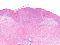 Histologie AGEP, acute gegeneraliseerde exanthemateuze pustulosis
