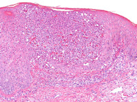 Histologie AGEP, acute gegeneraliseerde exanthemateuze pustulosis