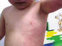 Asymmetrisch periflexuraal exantheem