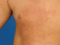 Asymmetrisch periflexuraal exantheem