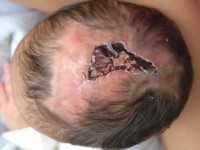 Adams-Oliver syndroom