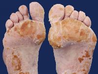 Bazex syndroom (acrokeratosis paraneoplastica)