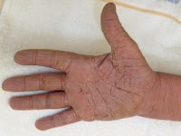 Bazex syndroom (acrokeratosis paraneoplastica)