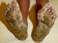 Bazex syndroom (acrokeratosis paraneoplastica)
