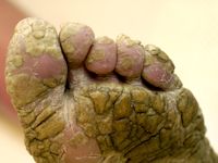 Bazex syndroom (acrokeratosis paraneoplastica)