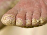 Bazex syndroom (acrokeratosis paraneoplastica)