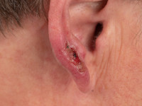 Borrelia lymfocytoom