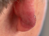 Borrelia lymfocytoom