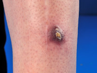 Borrelia lymfocytoom