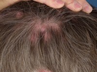 Brooke-Spiegler syndroom